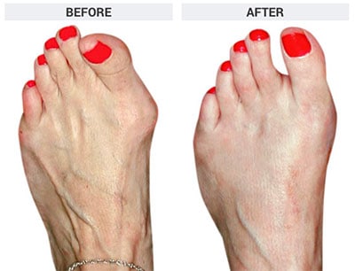 Osteotomy Bunionectomy, The Bunion Institute of Los Angeles