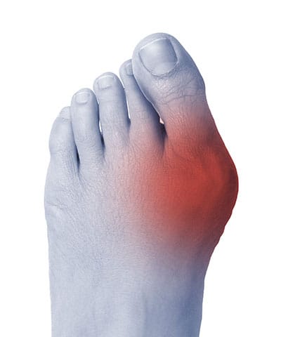 What's a Bunion, Bunion Institute of Los Angeles,