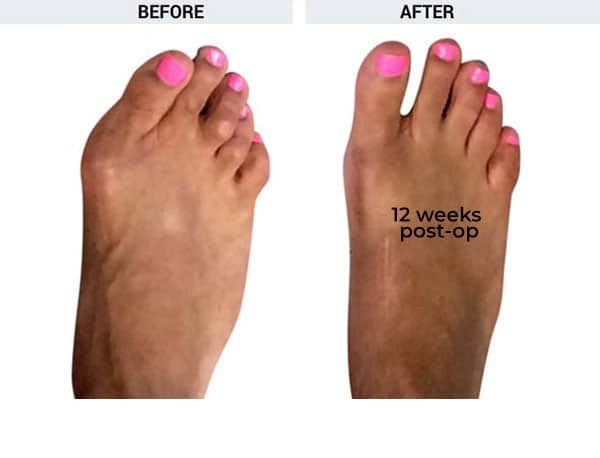 Forever Lapidus Bunionectomy with Hammertoe Correction