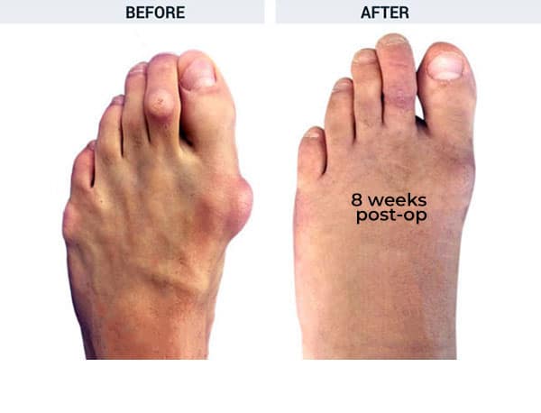 Forever Lapidus Bunionectomy with Hammertoe Correction