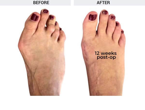 Forever Lapidus Bunionectomy with Hammertoe Correction