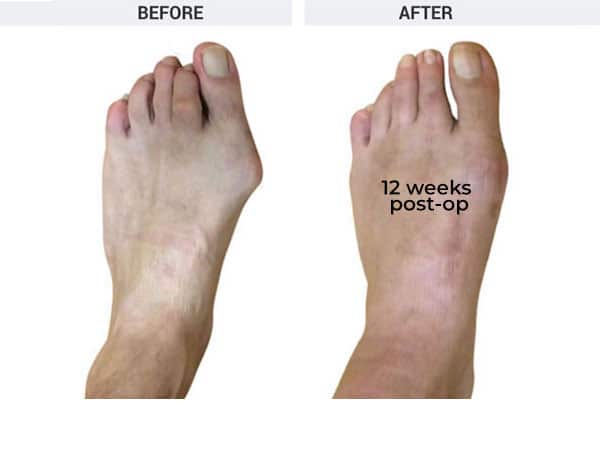 Forever Lapidus Bunionectomy with Hammertoe Correction