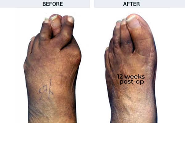 Forever Lapidus Bunionectomy with Hammertoe and Tailor's Bunion Correction