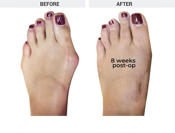 Forever Lapidus Bunionectomy with Tailor's Bunion Correction