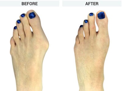 minibunion minimally invasive bunion surgery, The Bunion Institute of Los Angeles