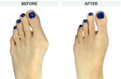 MINIMALLY INVASIVE BUNION SURGERY