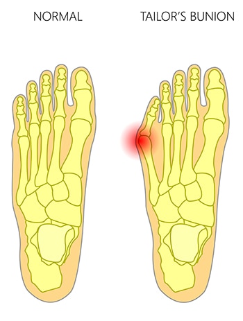 Anatomy of a tailor's bunion