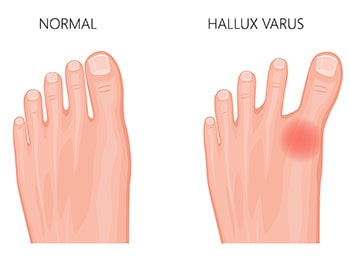 Hallux Varus vs healthy foot