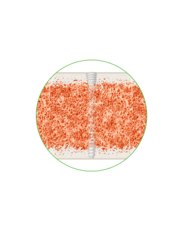 Illustration of ossio screw in bone