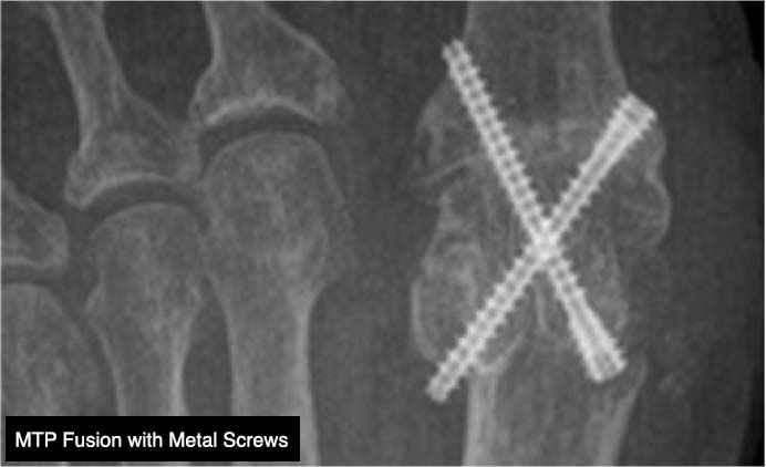 X-ray of a foot with 2 screws in it