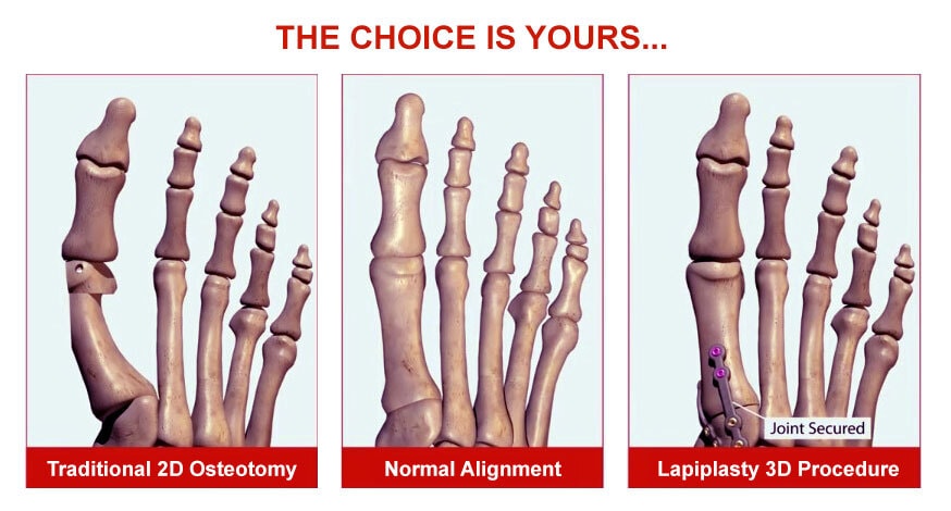 Lapiplasty before and after