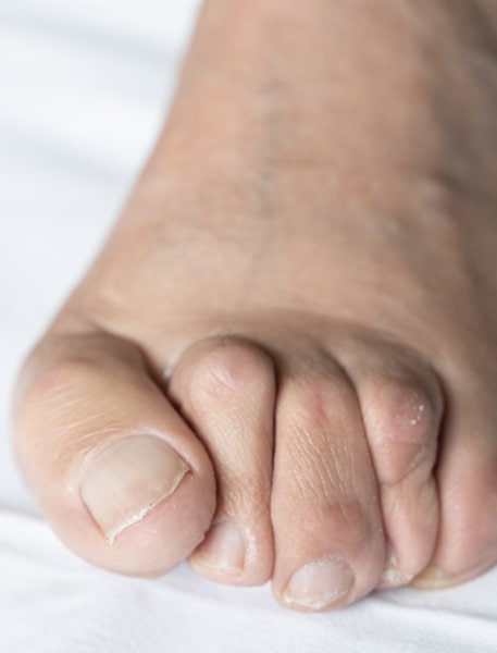 When do I need bunion surgery?