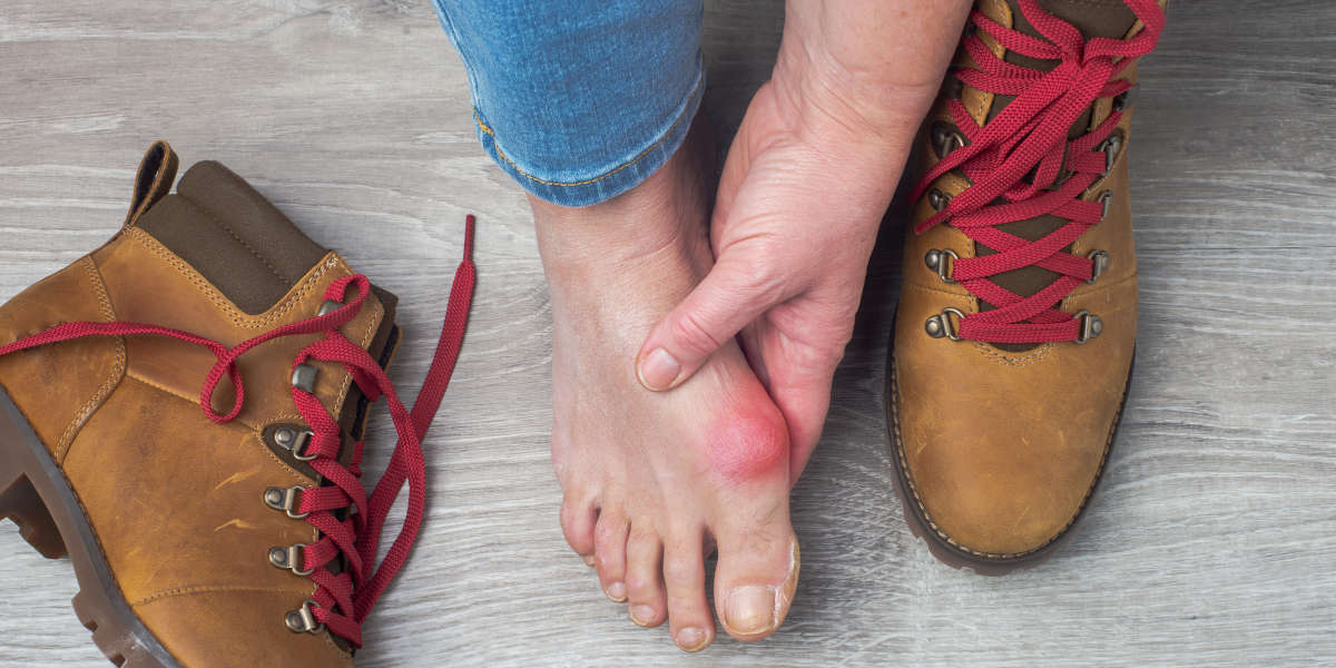 What To Do About Inflamed Bunions: Can I Prevent Bunion Inflammation?