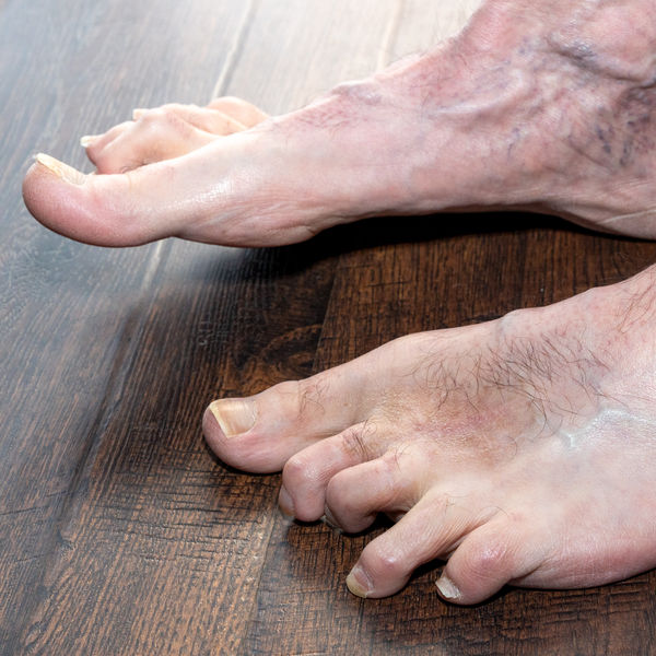 Foot with hammertoes