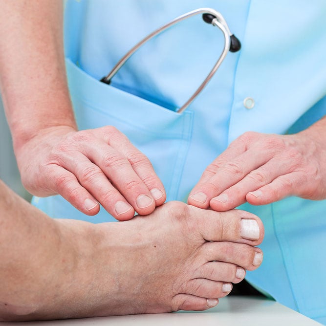 How-to-slow-bunions-down