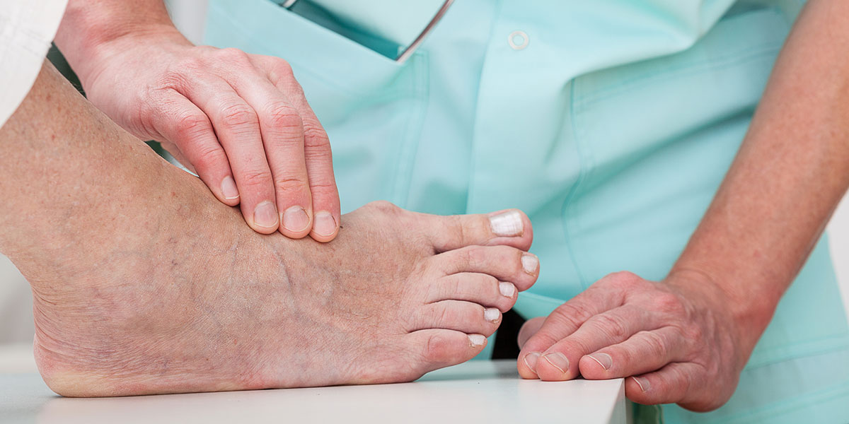 How Successful is Bunion Surgery? Avoid Painful Bunion Revision 