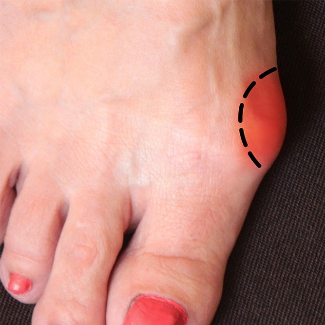 What are the different types of bunion surgery?